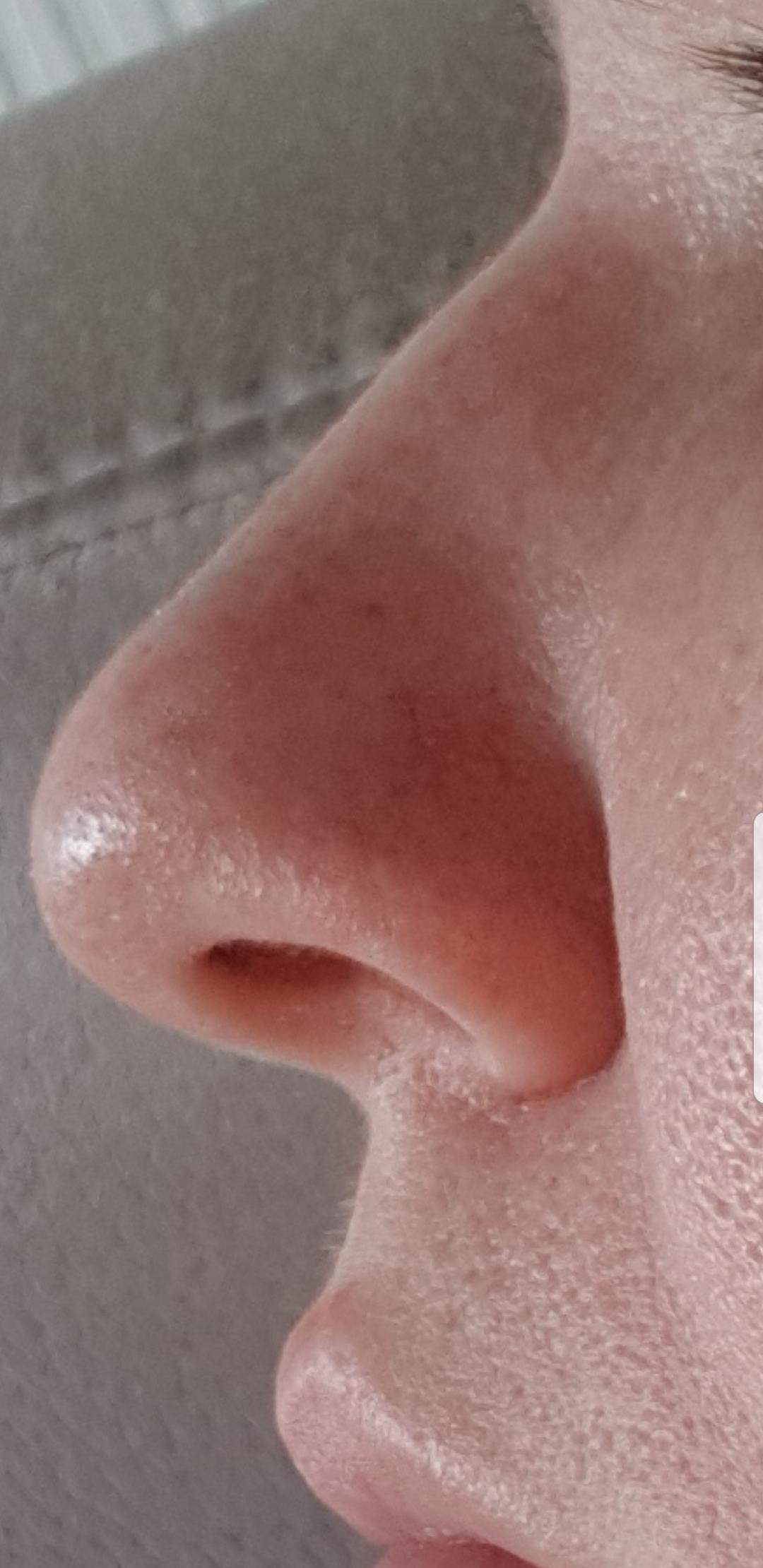 Wie Sieht Eiter Aus Der Nase Aus