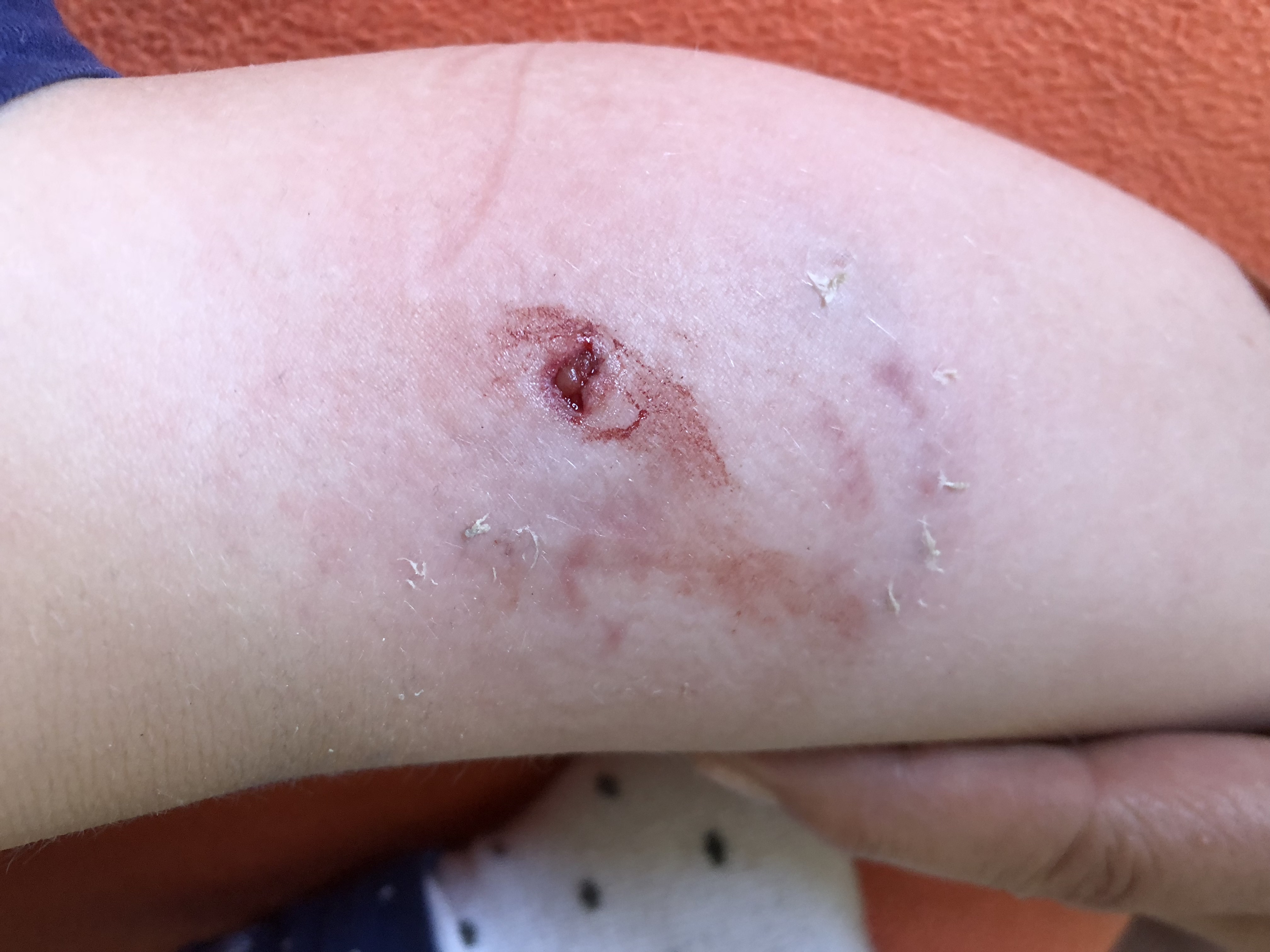 Tochter von Hund gebissen worden von Bekannter. Anzeige oder nur Versicherung? (Recht, Kinder Tochter von Hund gebissen worden von Bekannter. Anzeige oder nur Versicherung? (Recht, Kinder