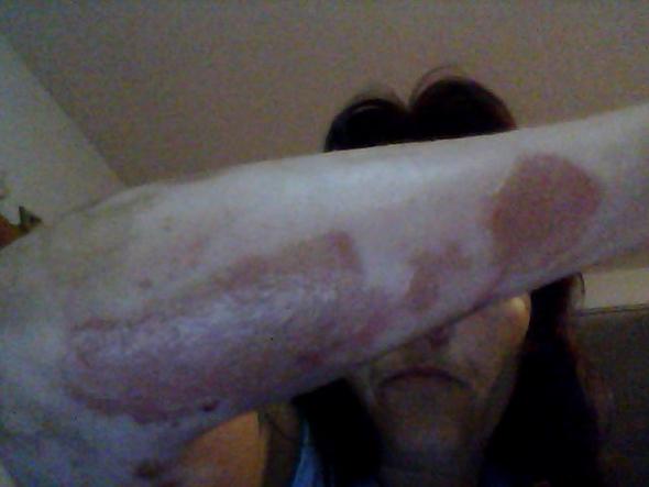 Das ist mein Arm das gleiche ist am Bauch auch noch mal - (Hautpflege, hauttransplantation)
