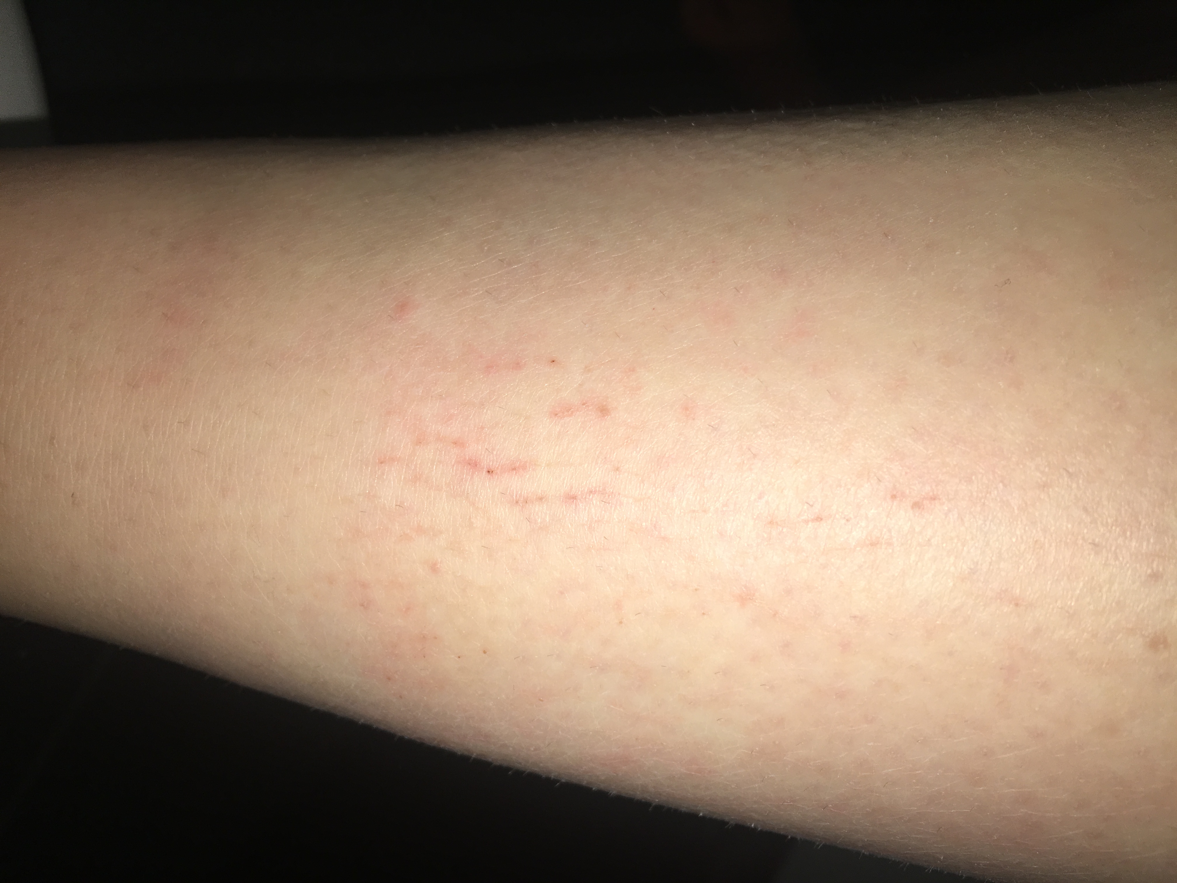 Trockene Gerissene Schienbeine Was Ist Das Gesundheit Hautprobleme