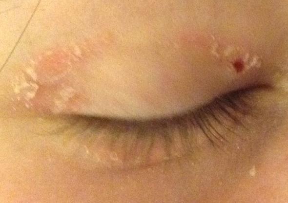 Trockene Haut Am Augenlid Medizin Arzt Krankheit