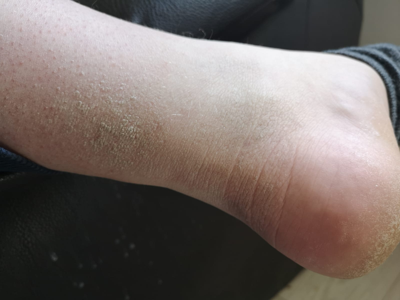 Trockene Haut am Bein/Hornaut was ist das? (Gesundheit und Medizin