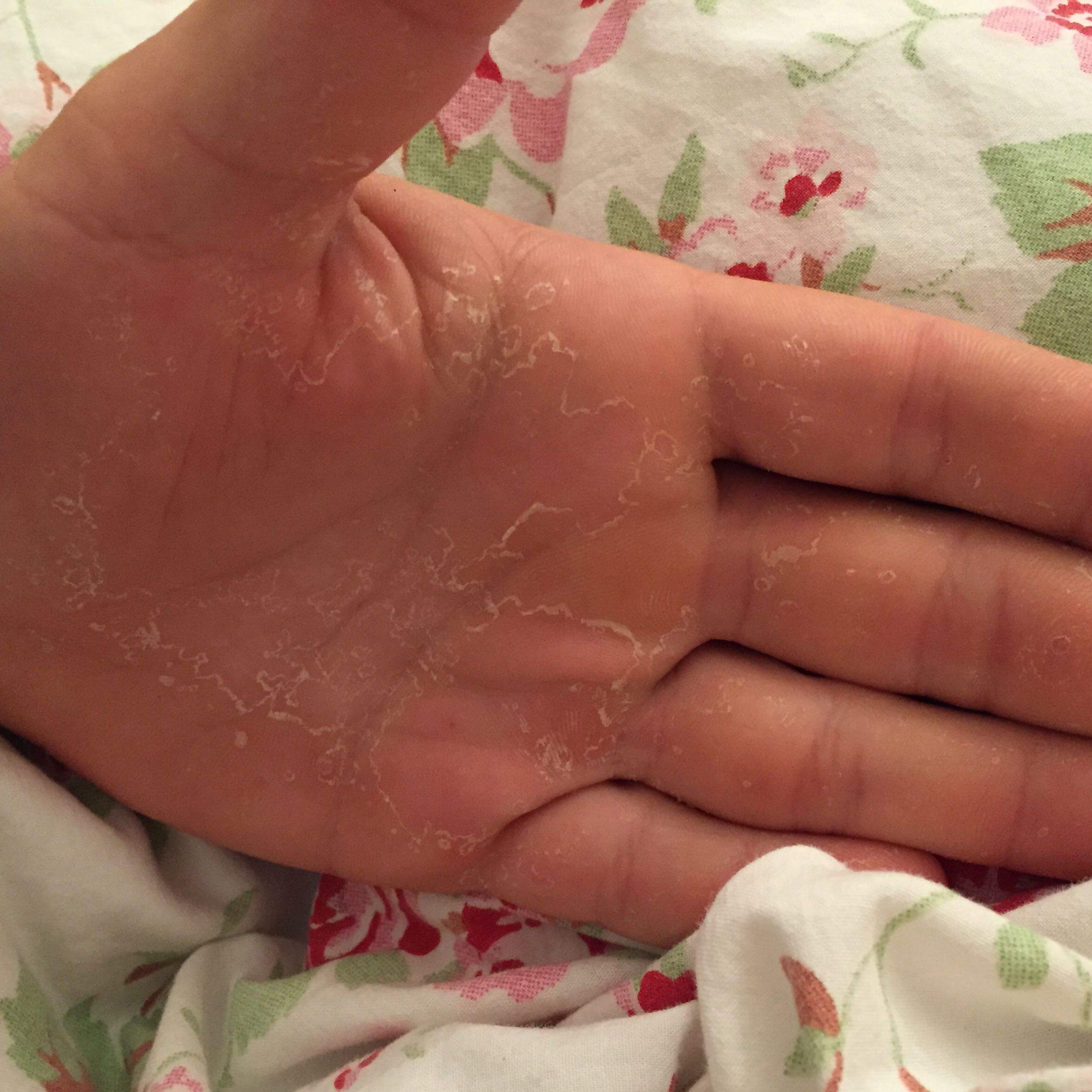 Trockene Haut Oder Pilz An Der Hand Ausschlag Schalen Trockene Haut Oder Pilz An Der Hand Ausschlag Schalen