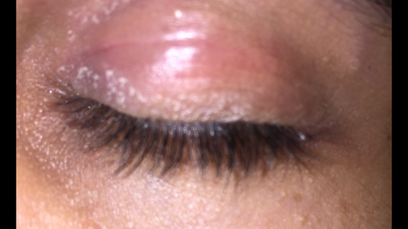 Trockene Kruste Auf Dem Linken Augenlid Was Ist Das Gesundheit Und Medizin