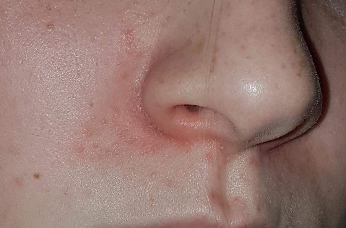 Trockene rote Haut um Nase? (Gesundheit und Medizin, Beauty, Gesicht)