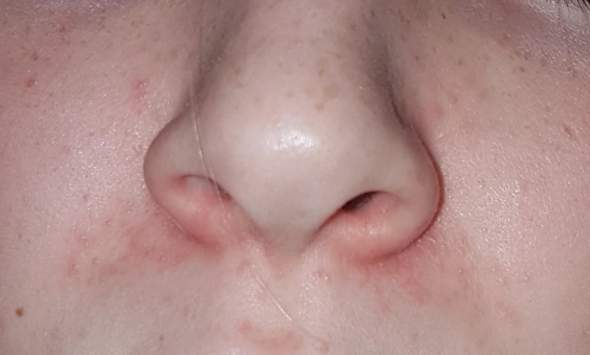 Haut nase trockene extrem Trockene Nase