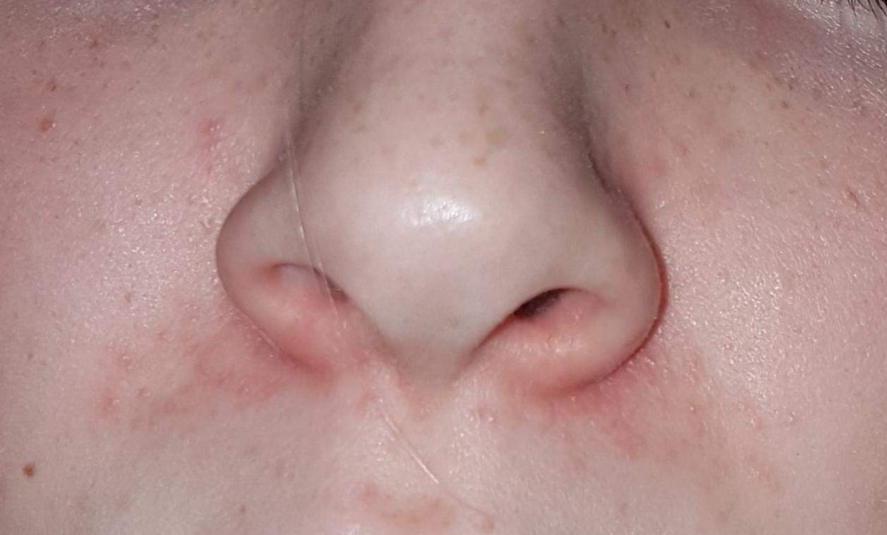 Trockene rote Haut um Nase? (Gesundheit und Medizin, Beauty, Gesicht)