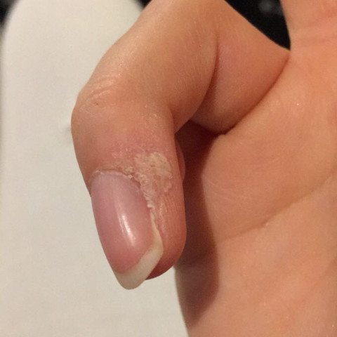 Stelle am Finger - (Gesundheit und Medizin, Arzt, Krankheit)