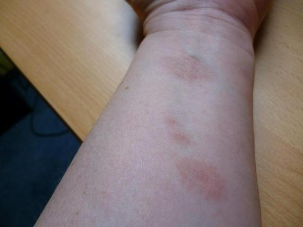 arm - (Medizin, Allergie)