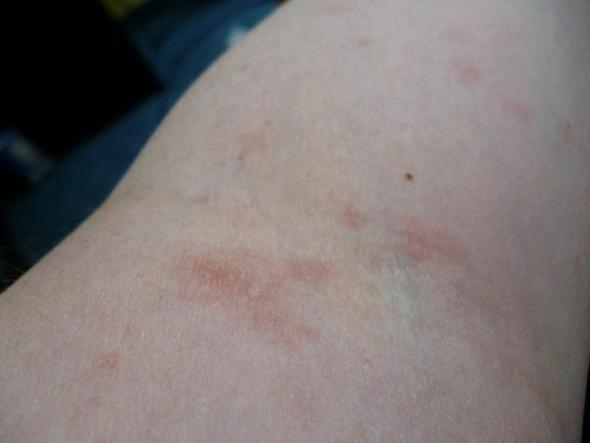 arm - (Medizin, Allergie)