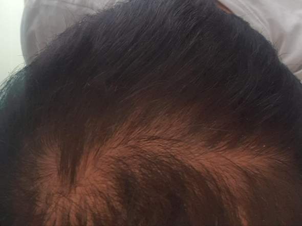 Trotz Haarausfall Am Hinterkopf Lange Haare Wachsen Lassen Bzw Manner Zopf Machen Gesundheit Und Medizin Gesundheit Beauty