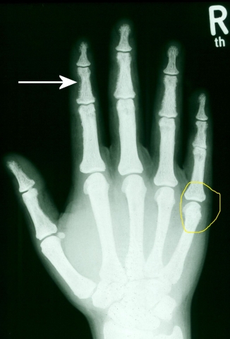 Trümmerbruch am kleinen Finger - Erfahrungsberichte (Fußball
