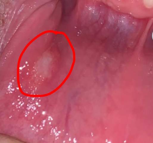 Gutartiger Tumor Im Mund Bilder