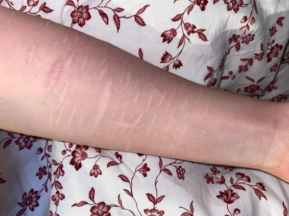 Tw Kann Man Meine Narben Covern Haut Tattoo Cover