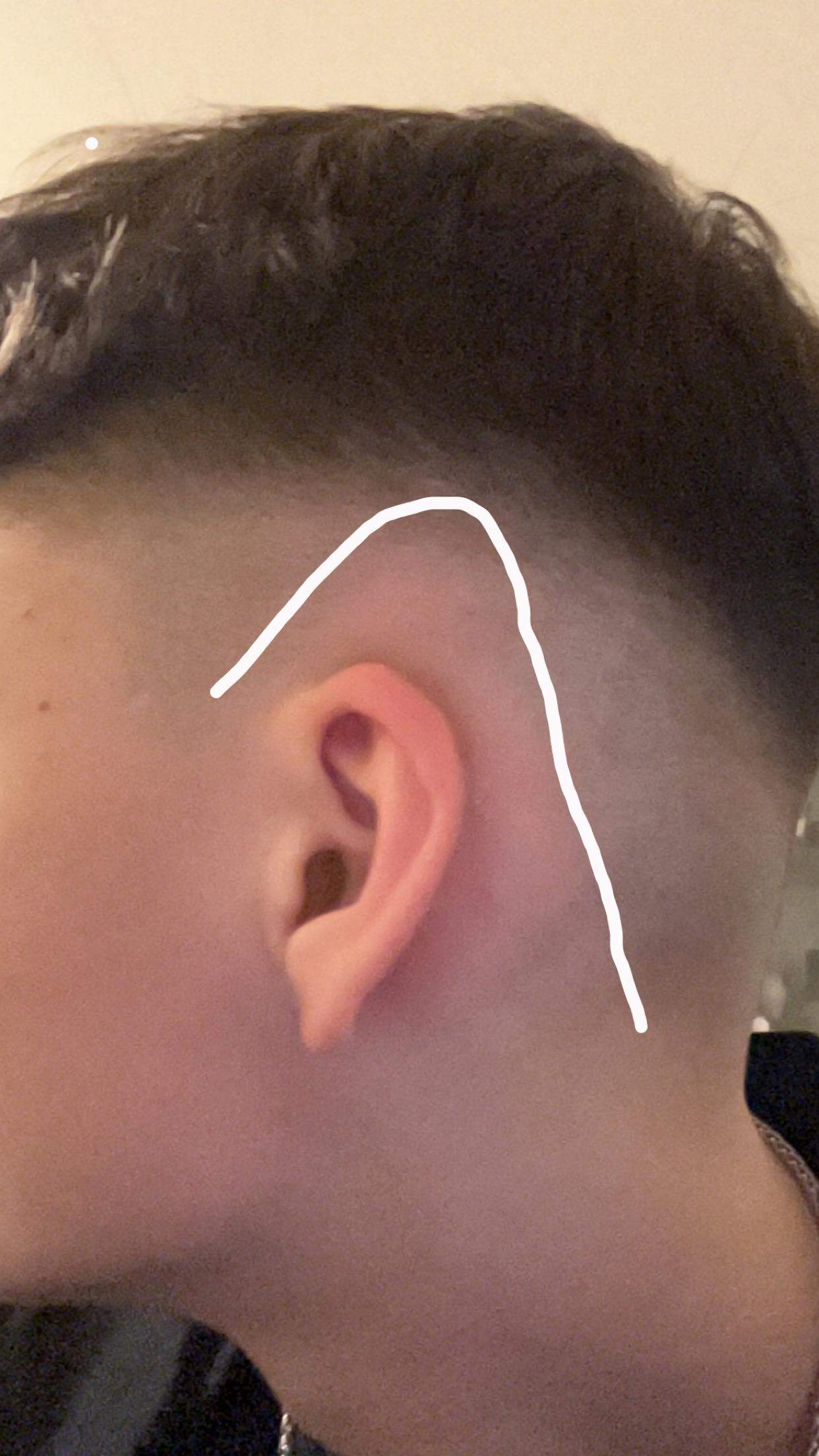 Über den Ohren keine haare? (Jungs, Haarausfall, Haarwachstum)