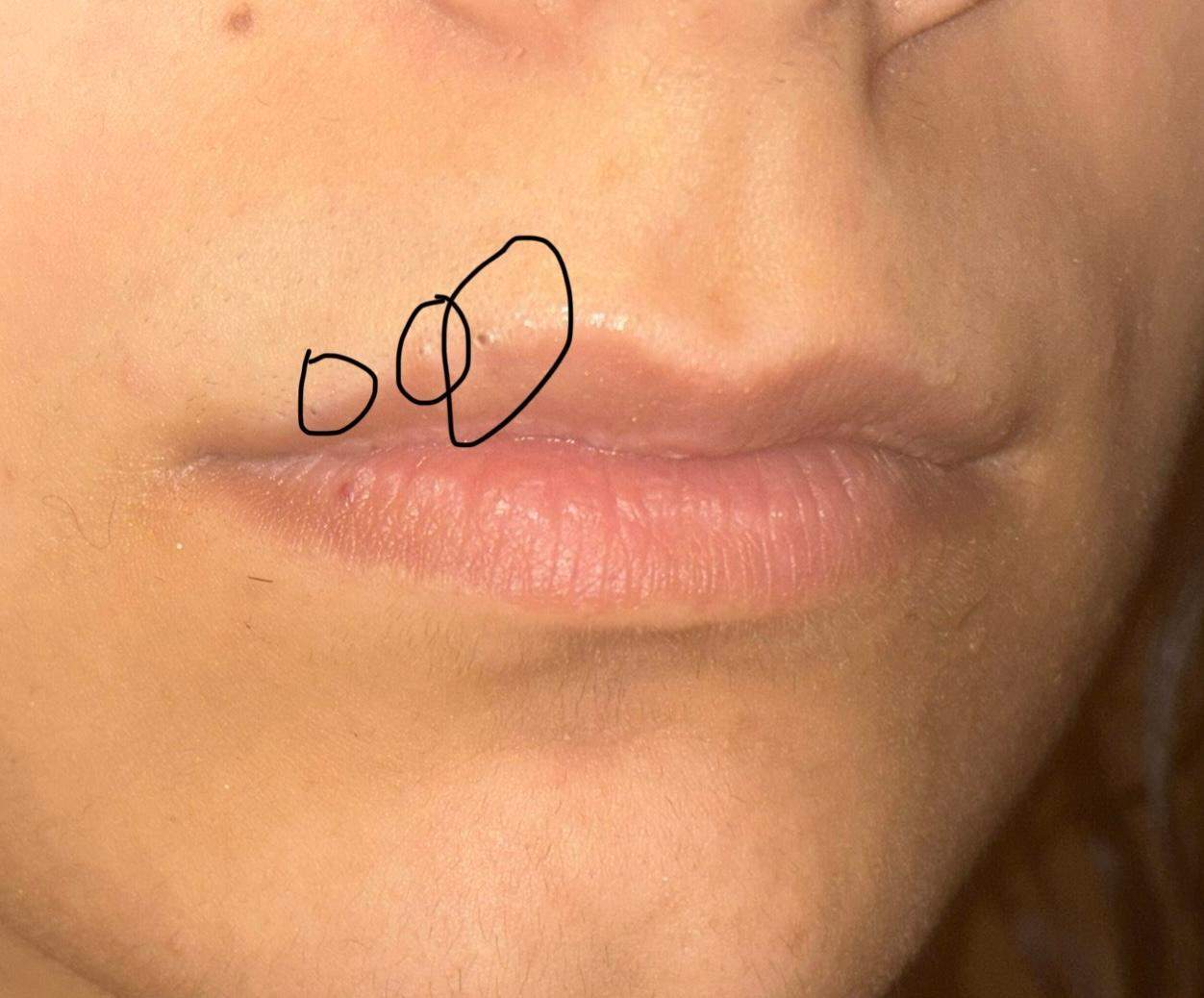 Über Lippe schwarze kleine pickel? (Haut, Pflege, Gesicht)