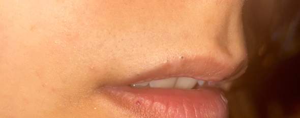 Über Lippe schwarze kleine pickel? (Haut, Pflege, Gesicht)