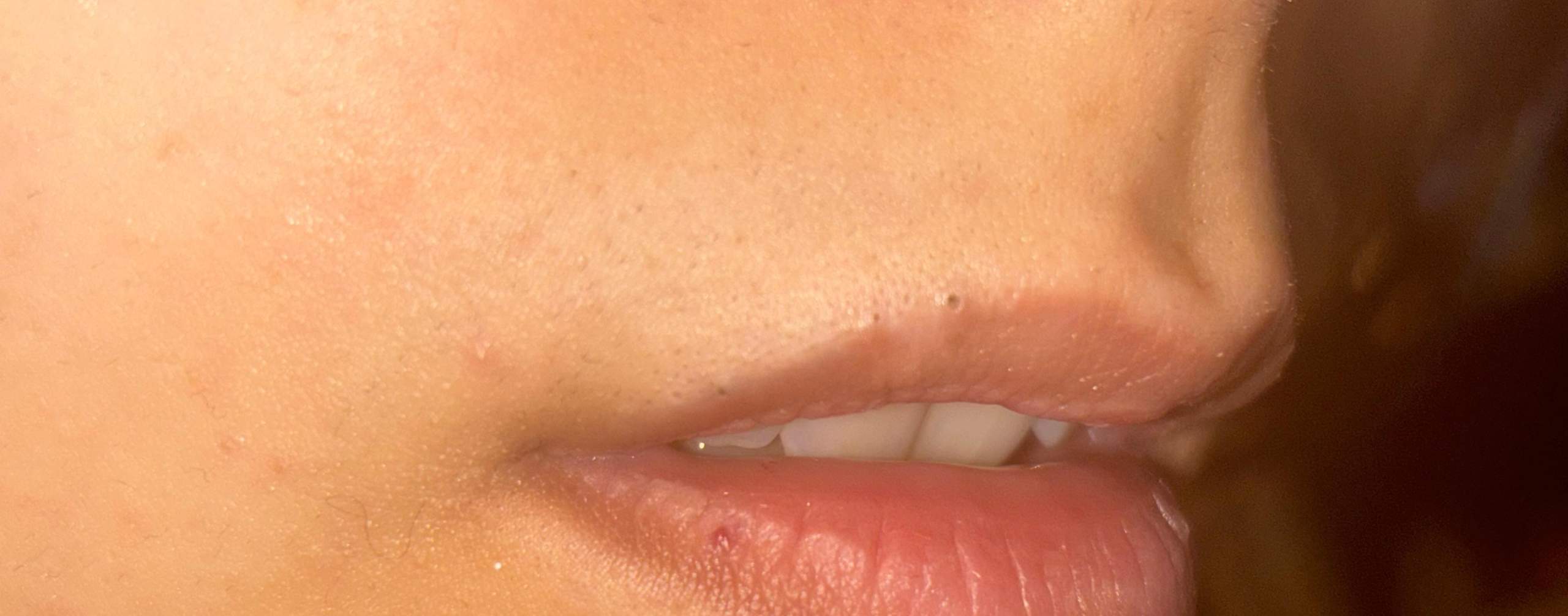 Über Lippe schwarze kleine pickel? (Haut, Pflege, Gesicht)