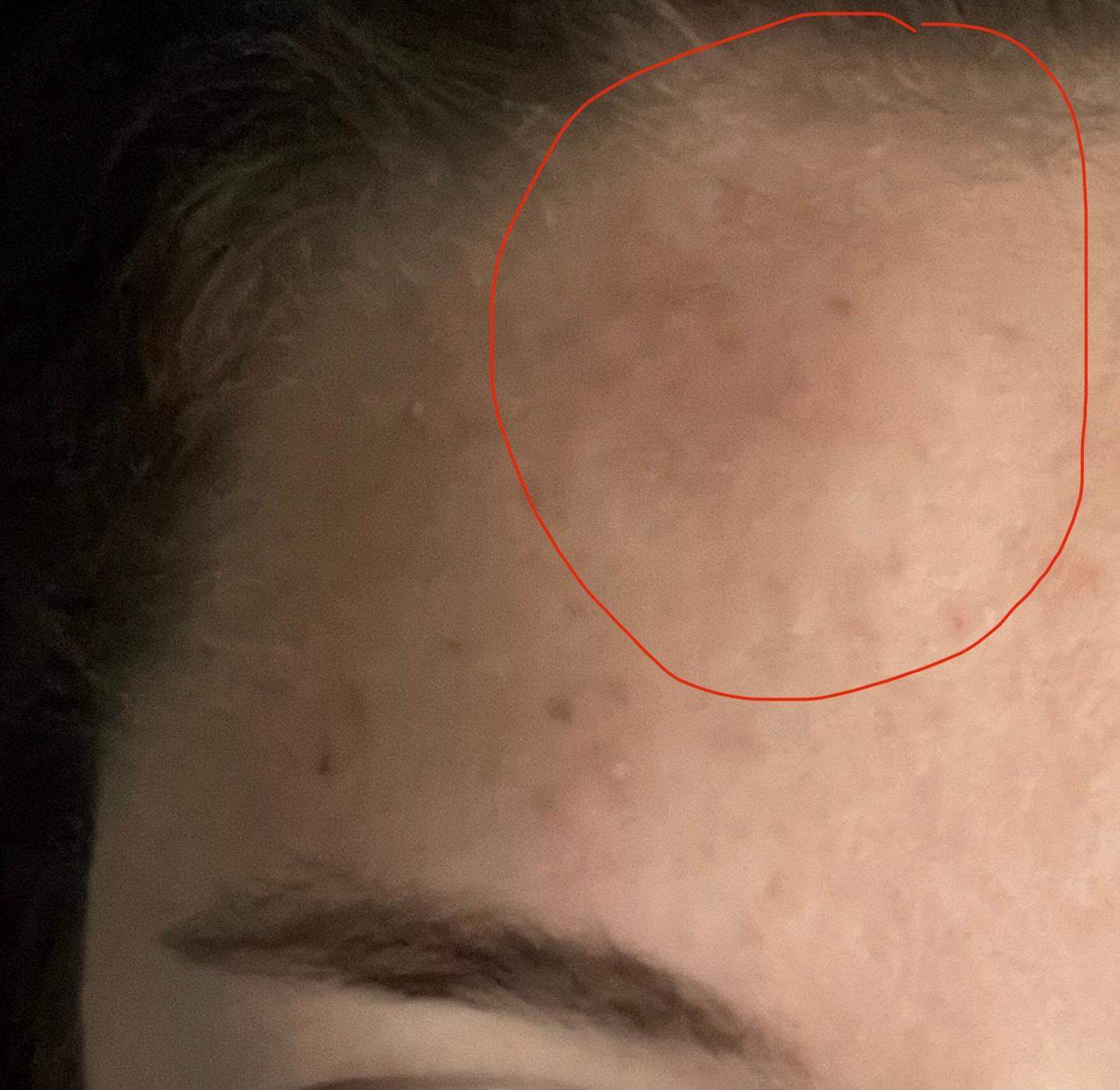 Beule Über Nacht eine Beule an der Stirn? (Gesundheit und Medizin)