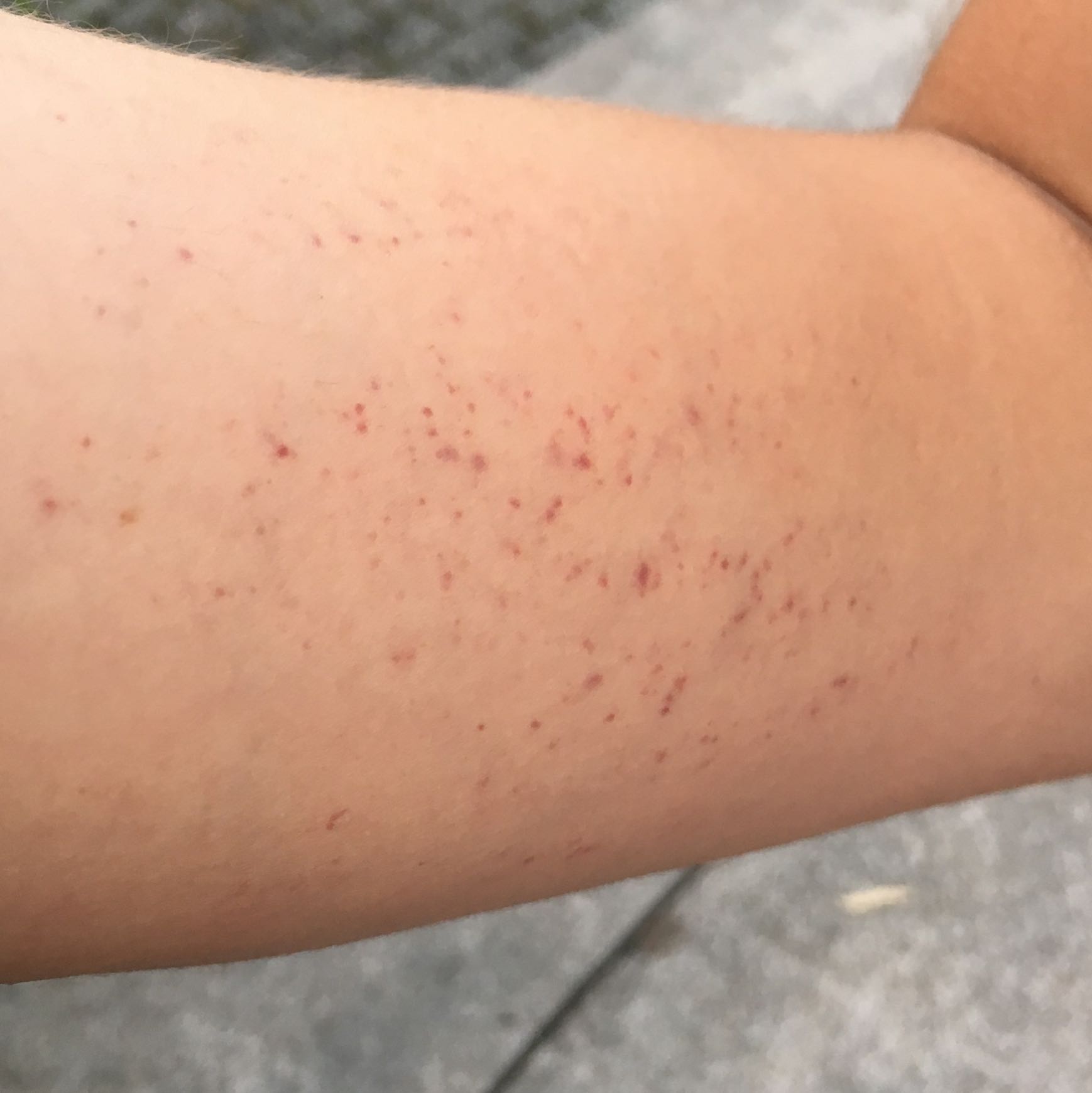 Über Nacht einen Ausschlag bekommen. Rot, auf dem Oberarm Innenseite Über Nacht einen Ausschlag bekommen. Rot, auf dem Oberarm Innenseite