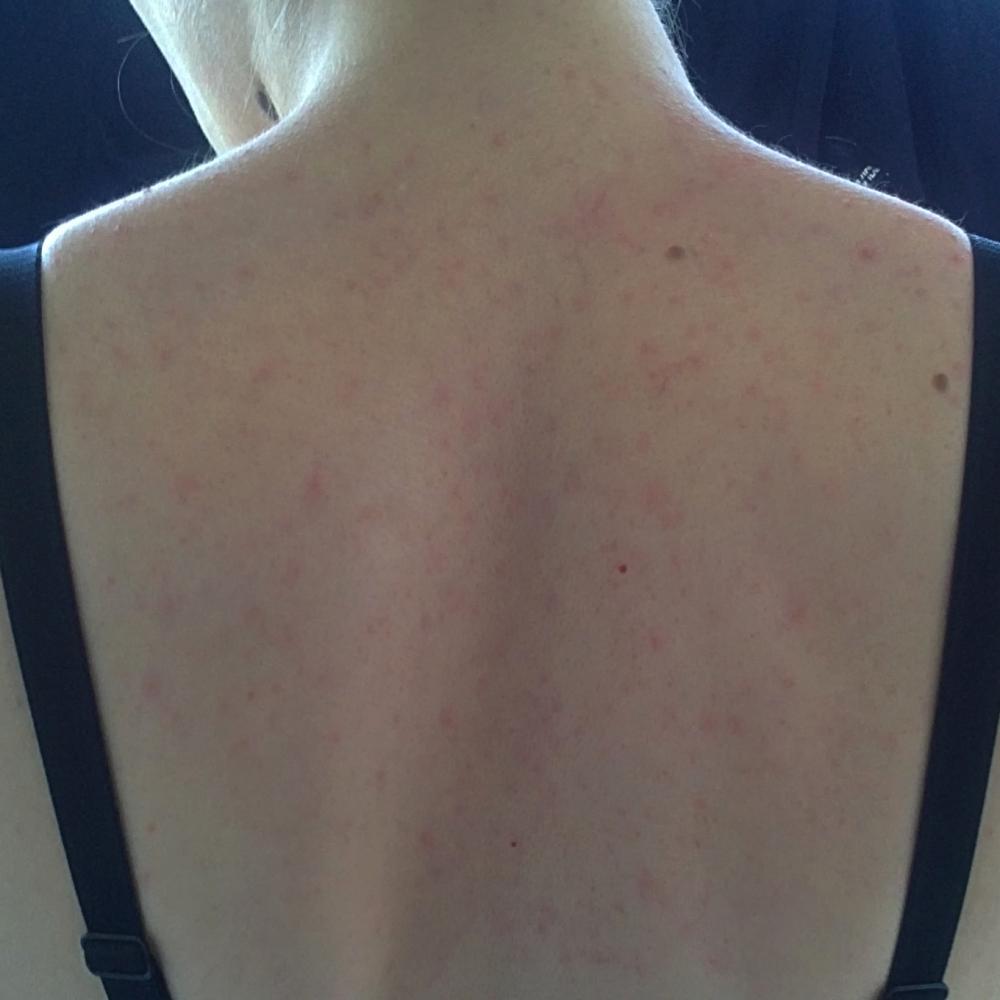 über Nacht komische Pickel auf dem Rücken (Krankheit, Haut, Allergie) pickel auf backe