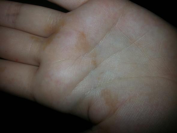 Uber Nacht Plotzlich Braune Flecken Auf Der Handflache Bekommen Was Ist Das Krankheit Hautkrankheit