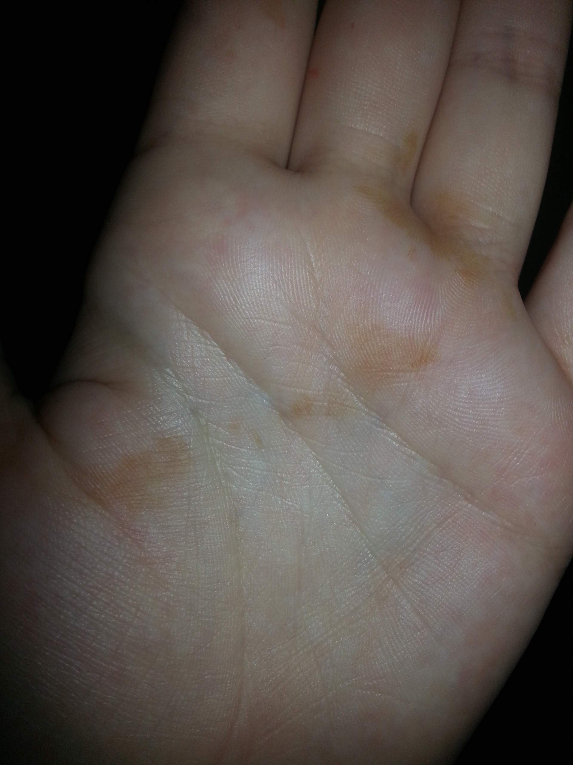Über Nacht plötzlich braune Flecken auf der Handfläche bekommen! Was ist das? (Krankheit Über Nacht plötzlich braune Flecken auf der Handfläche bekommen! Was ist das? (Krankheit