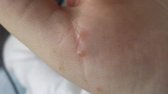 Uberall Blaschen An Der Hand Was Ist Das Gesundheit Und Medizin Haut Blaeschen Uberall Blaschen An Der Hand Was Ist Das Gesundheit Und Medizin Haut Blaeschen