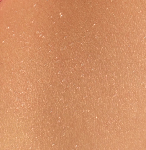 Meine Haut und ihre Blasen  - (Haut, Allergie, Sonne)