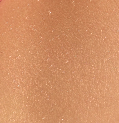 Uberall Blasen Auf Der Haut Sonnenbrand Sonne Allergie Uberall Blasen Auf Der Haut Sonnenbrand Sonne Allergie