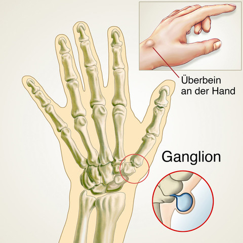 Uberbein An Der Hand Geht Nicht Weg Was Nun Medizin Ganglion Uberbein An Der Hand Geht Nicht Weg Was Nun Medizin Ganglion
