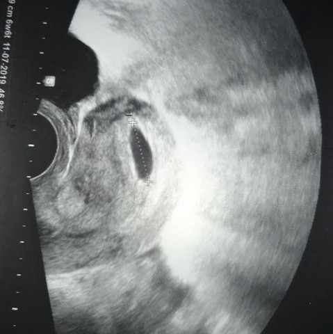 Ultraschall Bild 6+5 - (Gesundheit und Medizin, Schwangerschaft, schwanger)