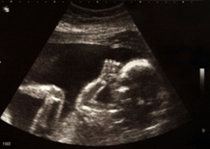 Ultraschall Kopf Baby