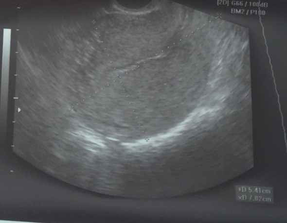 Schwangerschaft ultraschall gebärmutter ohne Kann man