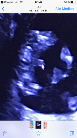 Ultraschallbild 17woche  - (Liebe und Beziehung, Mädchen, Schwangerschaft)