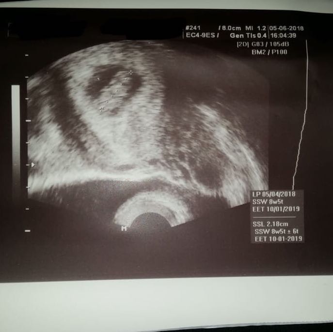 Ultraschallbild Zeugungsdatum Liebe Und Beziehung Sex