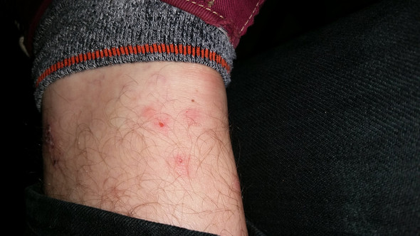 Um Was Fur Stiche Bzw Bisse Handelt Es Sich Auf Dem Foto Stich