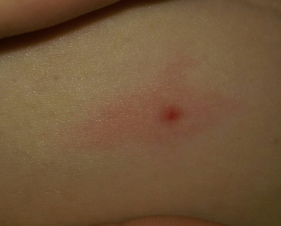 schwellung nach zeckenbiss hund