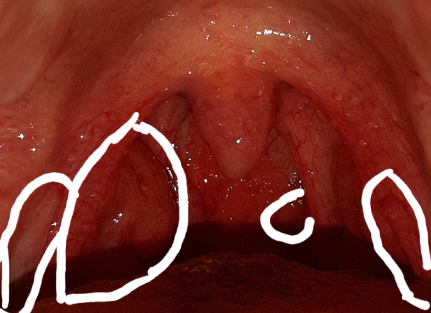 UMFRAGE! Ist das auf den Fotos normal (Rachenschwellung, Rachenentzündung, Entzündung der Lippe ...
