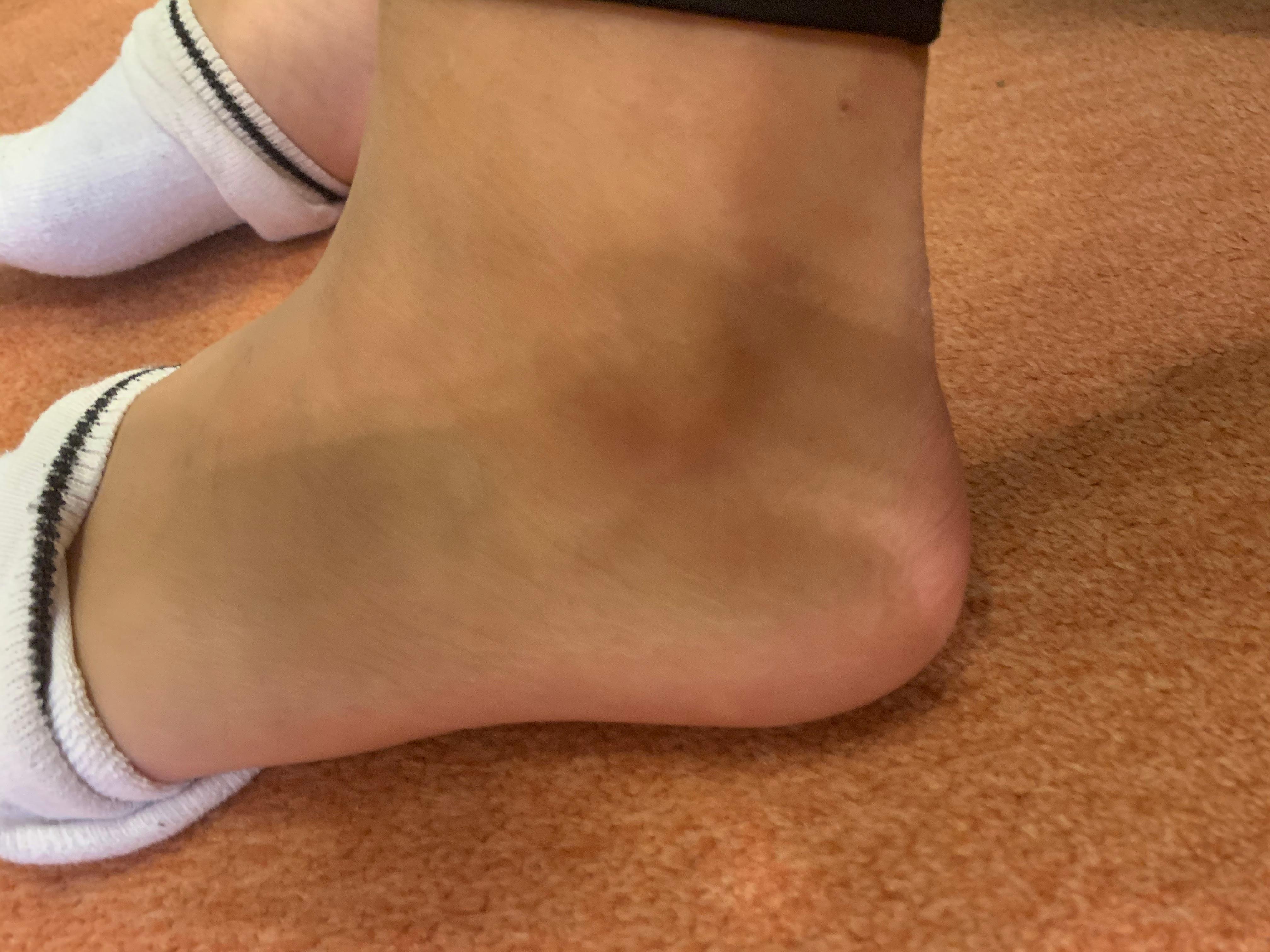 Umgeknickt Angeschwollen Gesundheit Und Medizin Gesundheit Verletzt