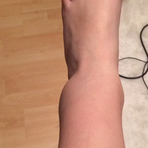 Umgeknickt 2 Wochen Spater Zum Arzt Fusse Tanzen Unfall Umgeknickt 2 Wochen Spater Zum Arzt Fusse Tanzen Unfall