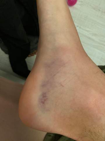 Umgeknickt Und Auf Der Anderen Seite Vom Fuss Blau Gesundheit Und Medizin Korper Arzt Umgeknickt Und Auf Der Anderen Seite Vom Fuss Blau Gesundheit Und Medizin Korper Arzt