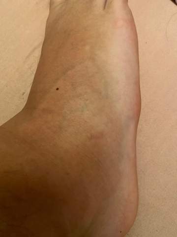 Umgeknickt Und Auf Der Anderen Seite Vom Fuss Blau Gesundheit Und Medizin Korper Arzt