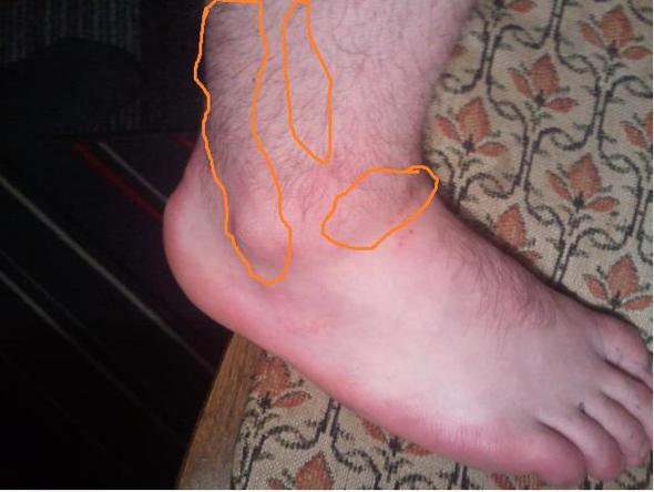 Umgeknickt Und Nach 6 Wochen Immer Noch Schmerzern Bitte Um Erfahrungsberichte Banderriss Umgeknickt Und Nach 6 Wochen Immer Noch Schmerzern Bitte Um Erfahrungsberichte Banderriss