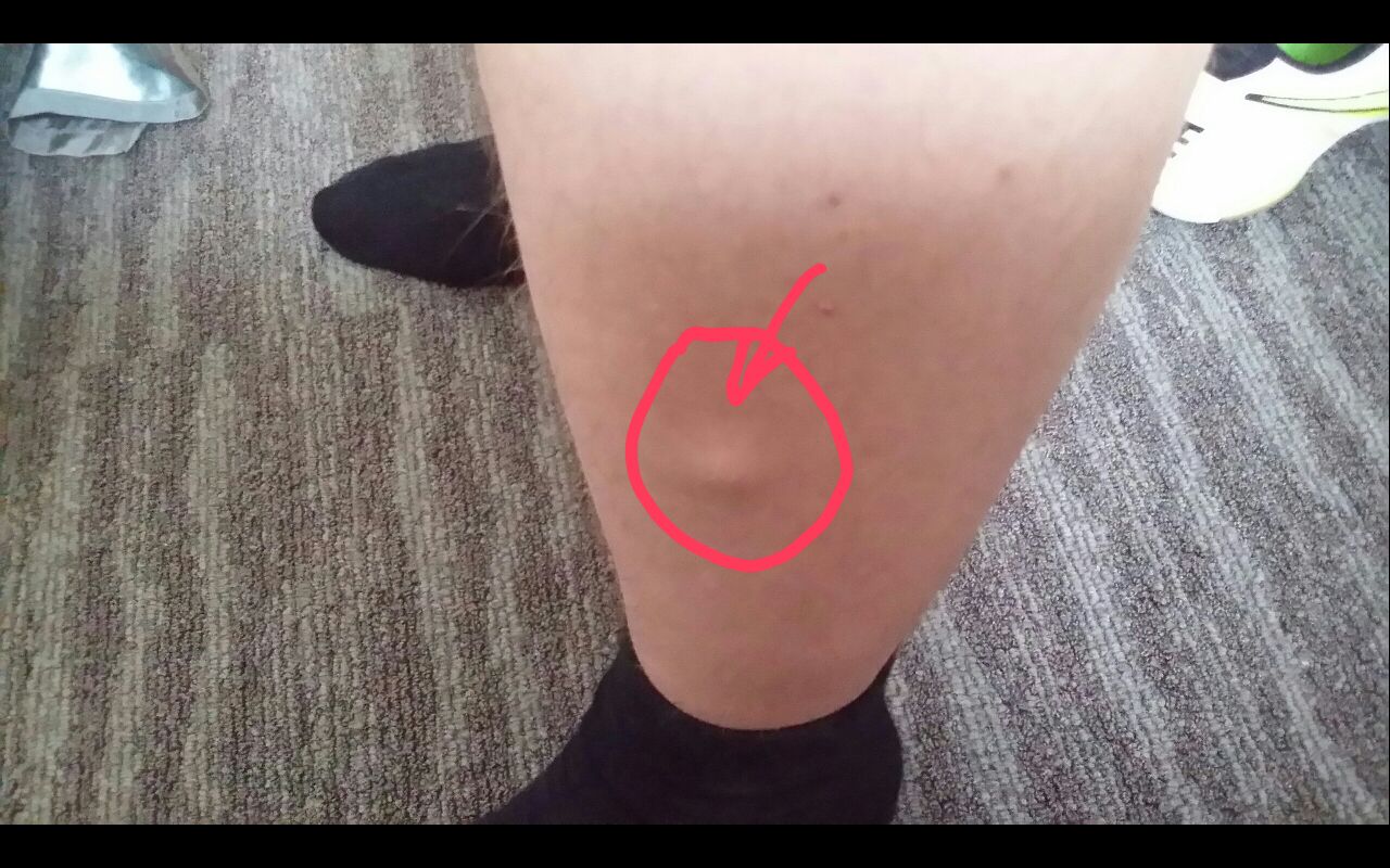 Unebenheit Beule Am Linken Bein Gesundheit Medizin Korper Unebenheit Beule Am Linken Bein Gesundheit Medizin Korper