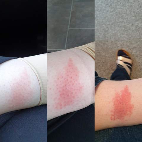 Ausschlag mückenstich ähnlicher Juckender Hautausschlag:
