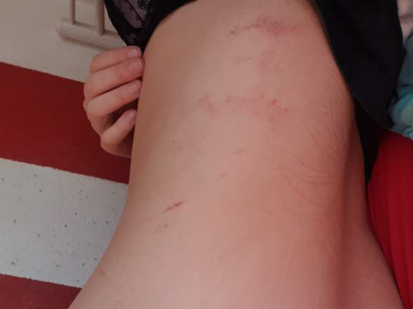 Ungewohnlicher Ausschlag Am Rucken Was Konnte Das Sein Gesundheit Haut Hiv Ungewohnlicher Ausschlag Am Rucken Was Konnte Das Sein Gesundheit Haut Hiv