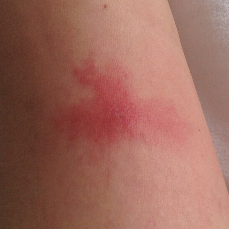 Ungewöhnlicher Mückenstich? (groß, mueckenstich)