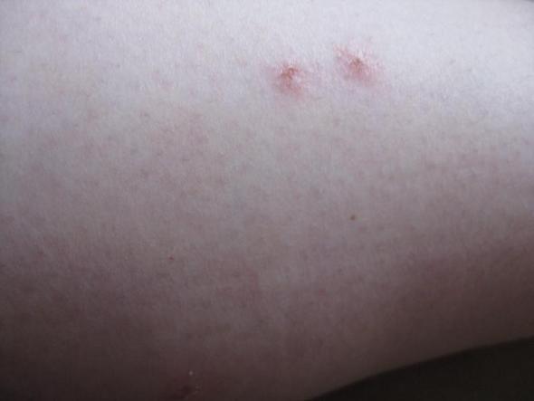 Stiche Von Bettwanzen Bilder Stiche Von Bettwanzen Bilder