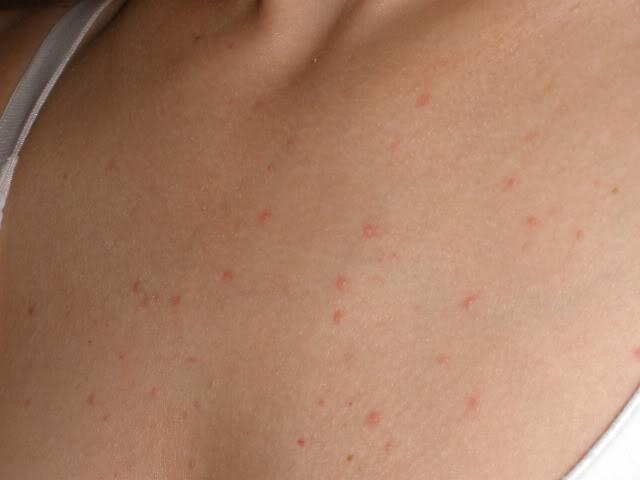 43+ Pickel Unter Der Haut Hals Images